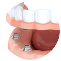 Implant Dentures