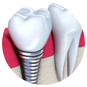 Implant Single Tooth