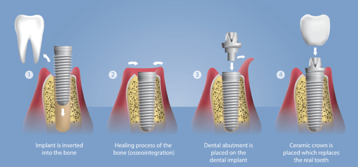 dental implant procedure diagram