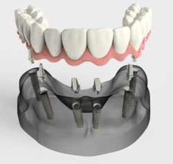 3D rendering of an all-on-four implant-secured denture