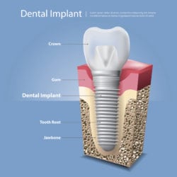 The dental implant experience newport news va