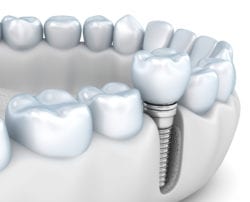 Implant Dentistry Hampton Roads VA