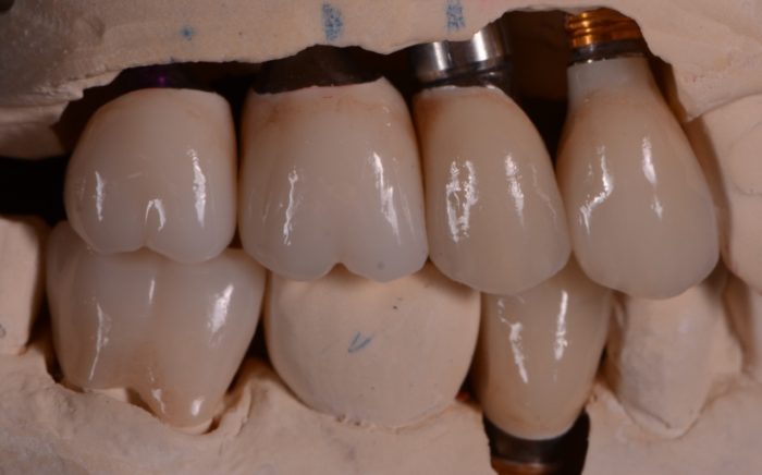 Replace Missing Teeth in Newport News, Virginia