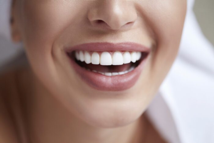 What to Know Before Getting Veneers