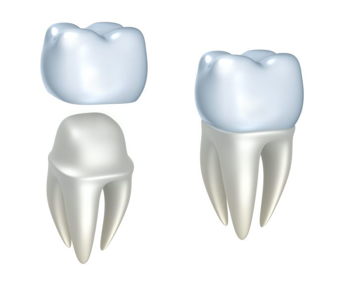 dental crowns in Hampton Roads va need extra care to stay strong and healthy